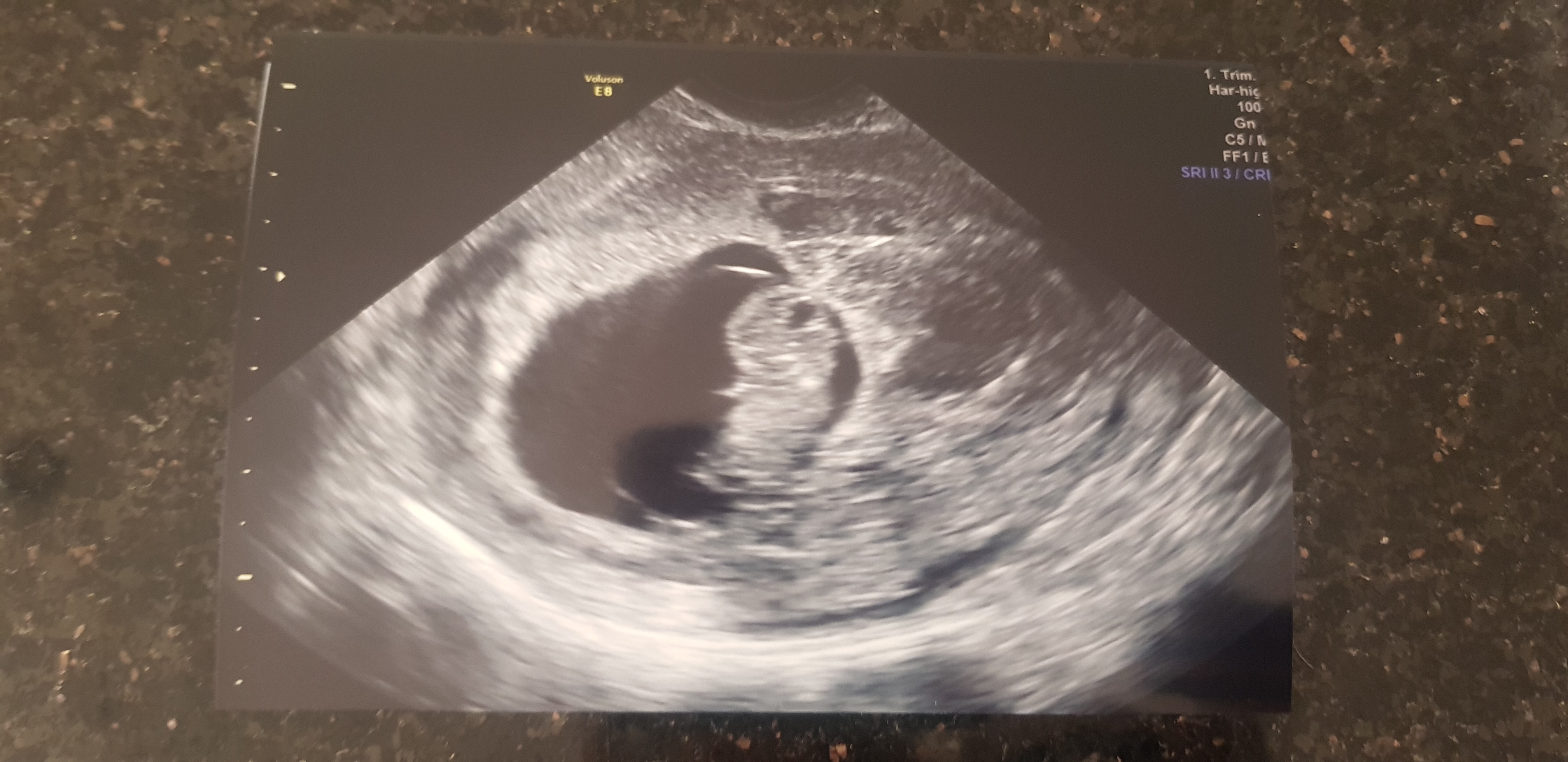 6-weeks-pregnant-spotting-when-wipe